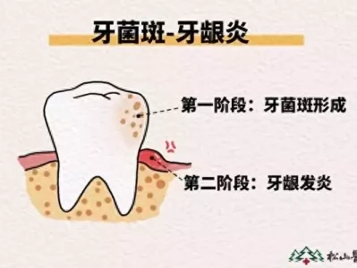 妊娠期牙龈炎易发 松山医院:孕期口腔保健很重要项羽乌江边自刎后,他手下的五大虎将,最后都是什么结局?