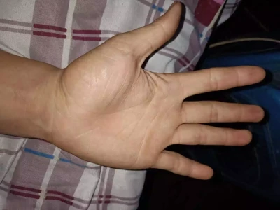 手心发热别忽视，背后可能藏着这些健康隐患！