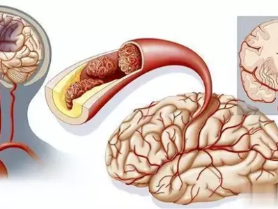高血压患者补这2种维生素，真能预防脑梗？必看！晚清名妓杨翠喜究竟有多美？看完这组绝版老照片，你就懂了