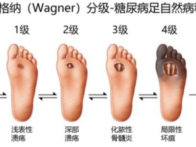 一个小伤口，海南阿叔险些截肢！这个病很多人都有……