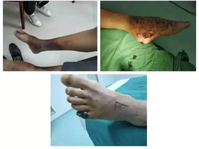 糖尿病足:糖友不可忽视的健康危机春天吃什么?