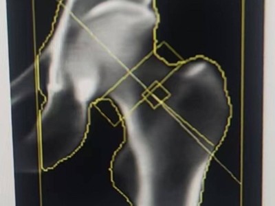 助力骨骼健康诊疗水平，镇江三五九医院先进骨密度仪“上线”