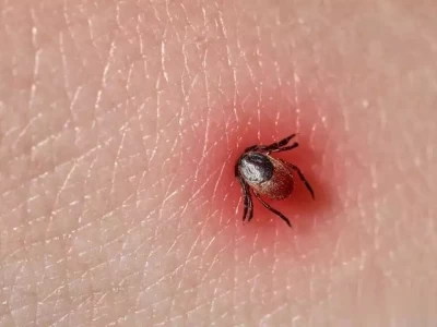 市疾控中心提醒：夏日户外活动小心蜱虫叮咬今年为何组织阅兵，5个方面释放信号