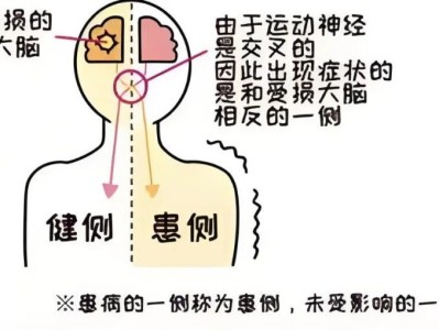 康复之路！偏瘫综合征患者的上肢康复训练方法科普→