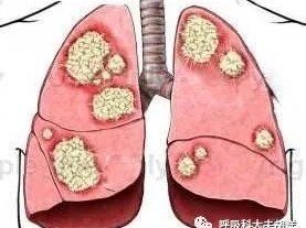 ​戒烟后为什么仍然会患肺癌，生活中需要注意哪些才能避免肺癌