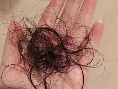 掉发频发，有人不当回事有人急就医，这4种病该重视吗？以色列军工企业公开击沉中国054A军舰，外交部当场精准亮剑