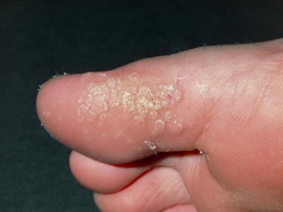 住酒店光脚洗澡后染HPV长跖疣？专家：属低危型，光脚接触易传染