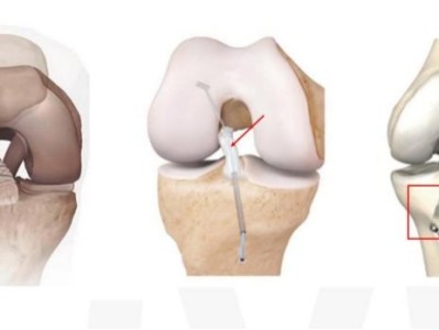华山医院运动医学团队牵头发表前交叉韧带修补国际专家共识声明