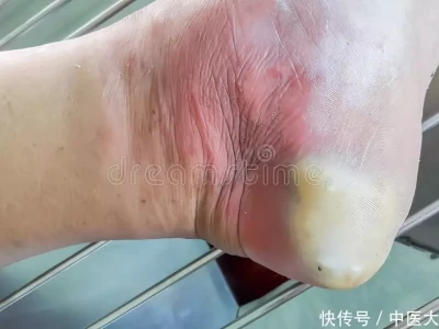 52岁女子，坚持每天泡脚改善糖尿病足，一年后她的健康情况如何？挑着扁担考大学，被央视、人民日报、新华网点名后，恶心事发生了