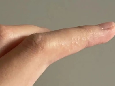 这种夏天手上爱长的小水疱，怎么对付？