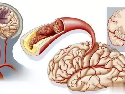 高血压患者补这2种维生素，真能预防脑梗？必看！晚清名妓杨翠喜究竟有多美？看完这组绝版老照片，你就懂了