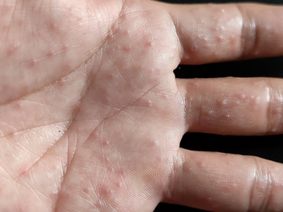 汗疱疹反反复复，怎么减少发作？