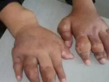 查出高尿酸，医生提醒少碰3种“发物”，病情或好转