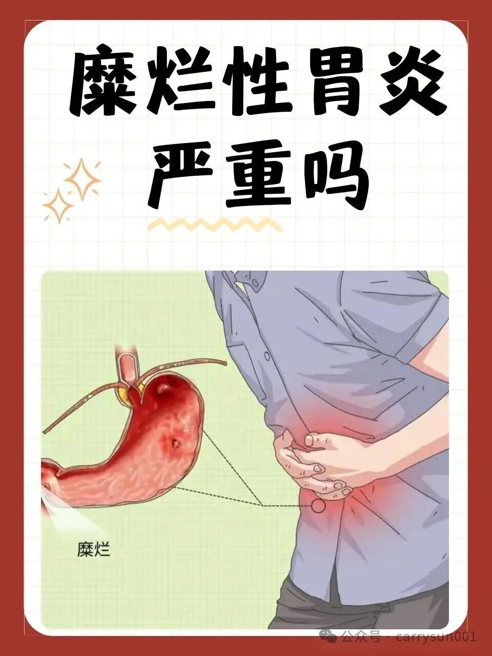 老百姓说的“胃糜烂（糜烂性胃炎）”到底是个啥？