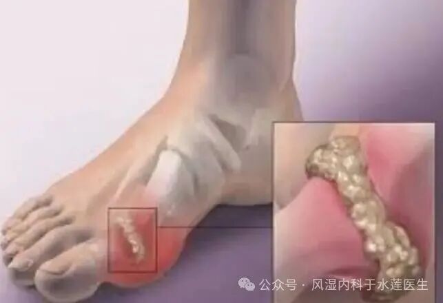 止痛、降酸、防复发：一文看懂痛风三类常用药怎么选！